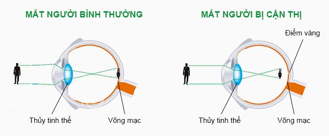 Mắt của người bình thường và mắt của người bị cận thị