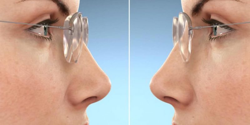 sự khác biệt giữa tròng kính siêu mỏng với tròng kính thường
