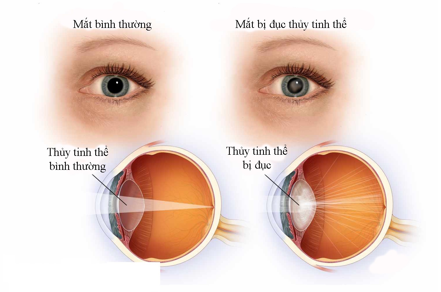 Bệnh đục thủy tinh thể ở mắt