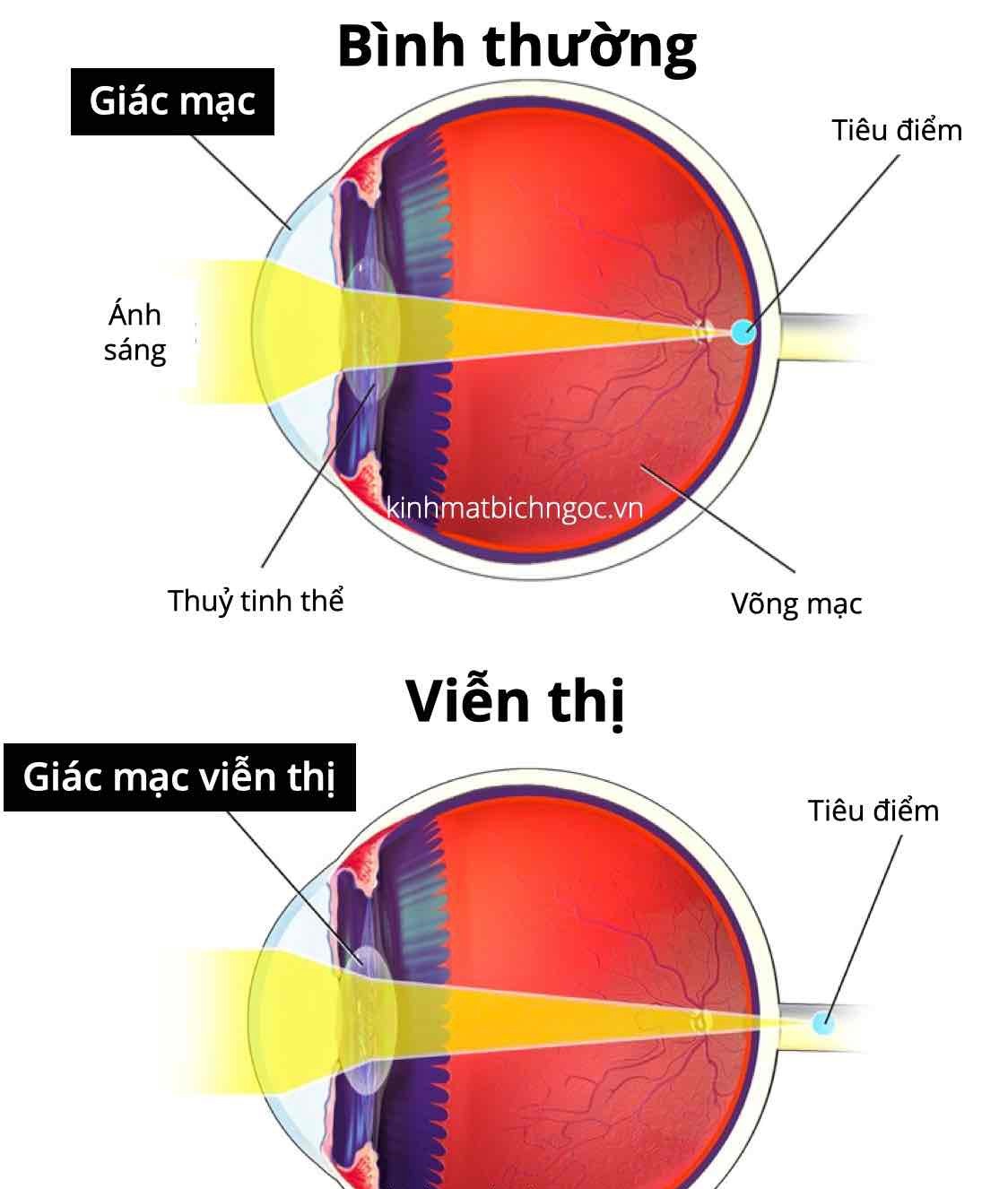 Hình ảnh phân biệt mắt bình thường và mắt viễn thị