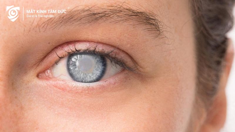 Đục thủy tinh thể khiến mắt trở nên mờ đục, giảm khả năng nhìn