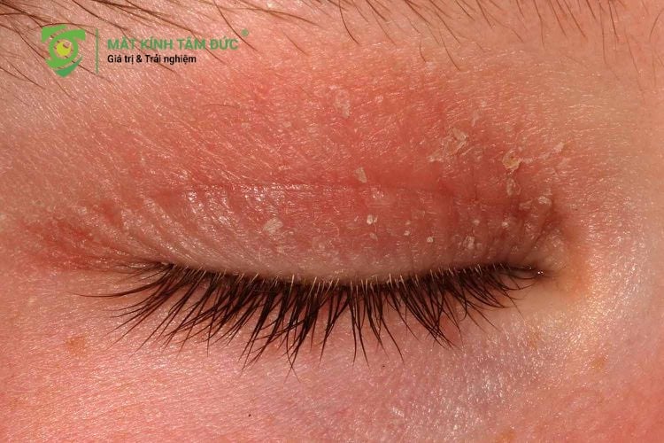 Viêm da tiếp xúc và nấm da mắt do dùng chung kính cận không vệ sinh.
