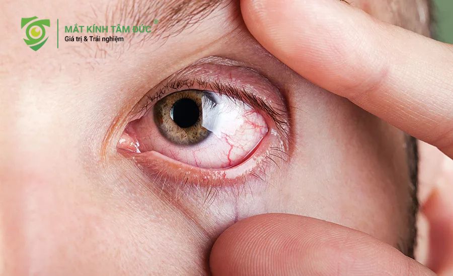 Cách xử lý an toàn khi bị bụi bay vào mắt Tại sao tuyệt đối không được dụi