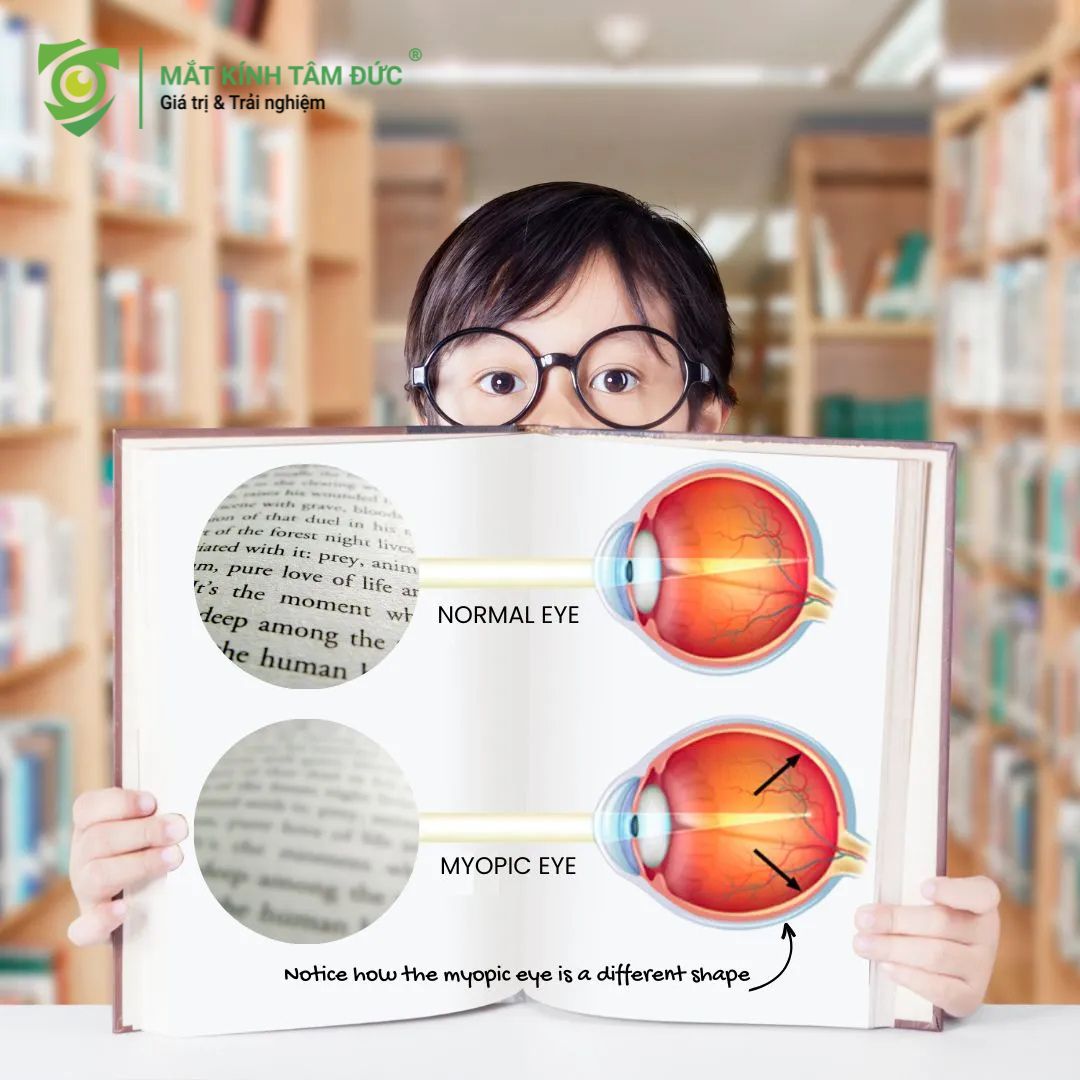 Nguyên nhân gây ra cận thị âm thầm trong cuộc sống hiện đại.