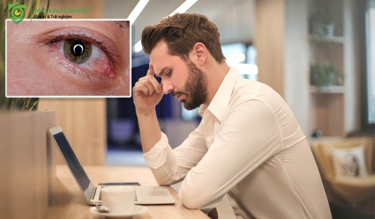 hội chứng thị giác màn hình này gây tăng độ cận và chảy nước mắt sống
