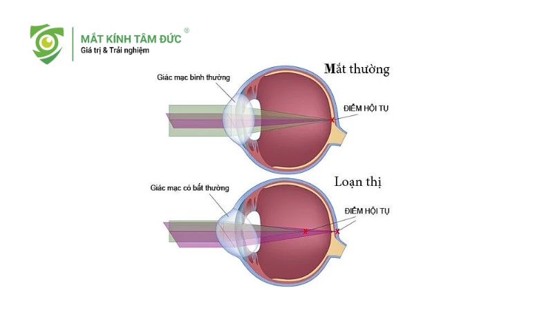 Loạn thị có cần đeo kính không và cách chọn kính phù hợp