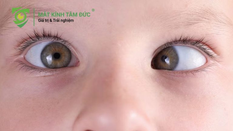Mắt lác là gì? Nguyên nhân, dấu hiệu và cách điều trị hiệu quả nhất 2026.