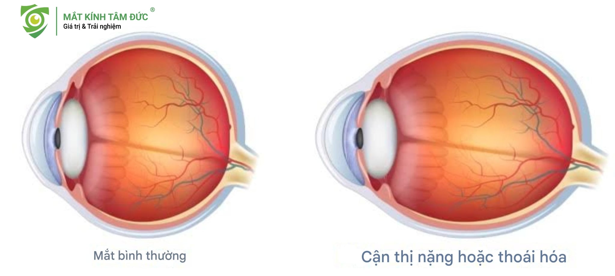 Biến dạng trục nhãn cầu do nhìn điện thoại quá gần khiến mắt điều tiết quá mức dẫn đến trục nhãn cầu dài ra và tăng độ cận.