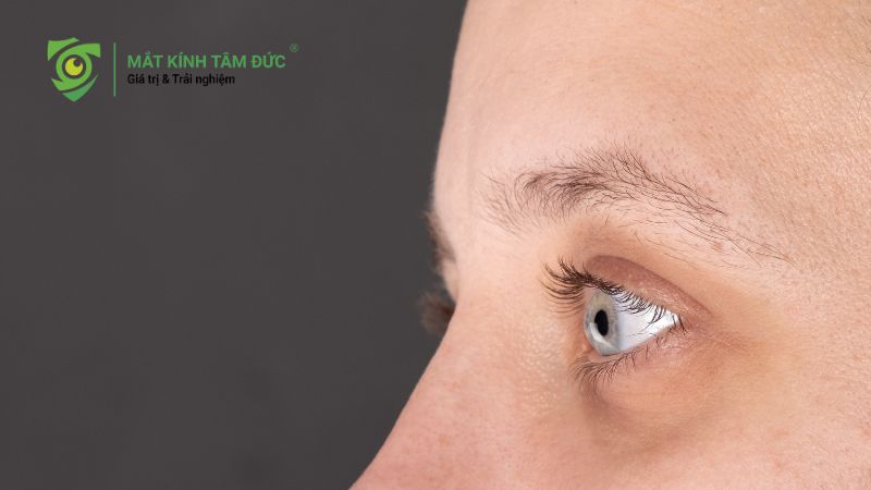 Giác mạc chóp là gì? 9 triệu chứng cảnh báo bạn không nên bỏ qua