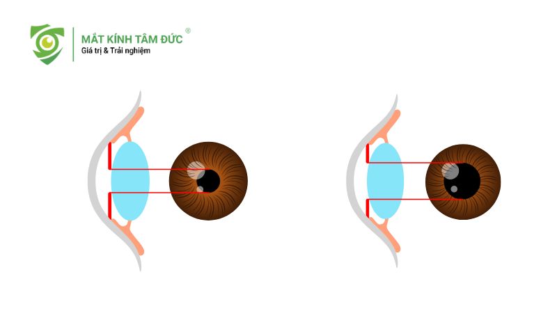 Giãn đồng tử là gì? Nguyên nhân và phương pháp xử lý hiệu quả